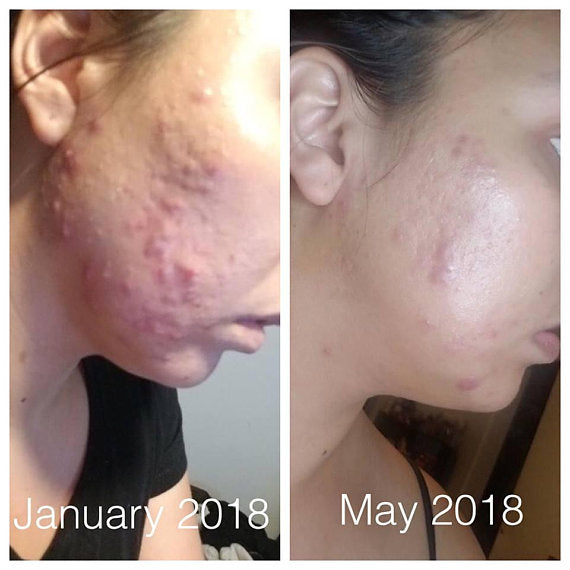 Super Acne Fighter / Organic Acne Treatment / Acne - Craze Trends