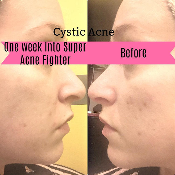 Super Acne Fighter / Organic Acne Treatment / Acne - Craze Trends